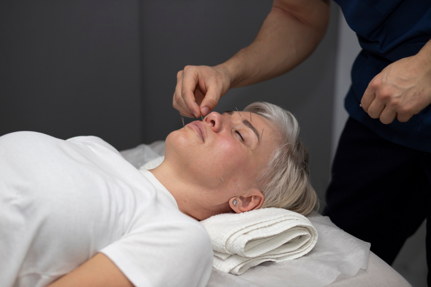 Medicinska akupunktura